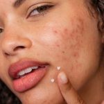 Dermalogica Post Breakout Fix 15ml - Image 3